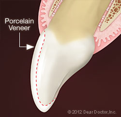 porcelain-veneer