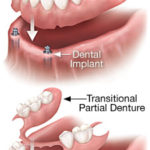 removable-denture-types