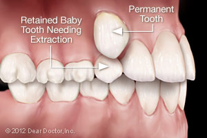 retained-baby-tooth
