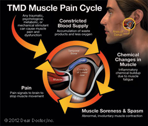 tmd-pain-cycle-thumb