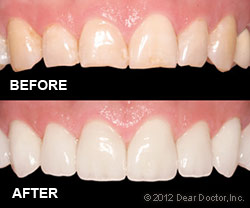 veneers-before-after